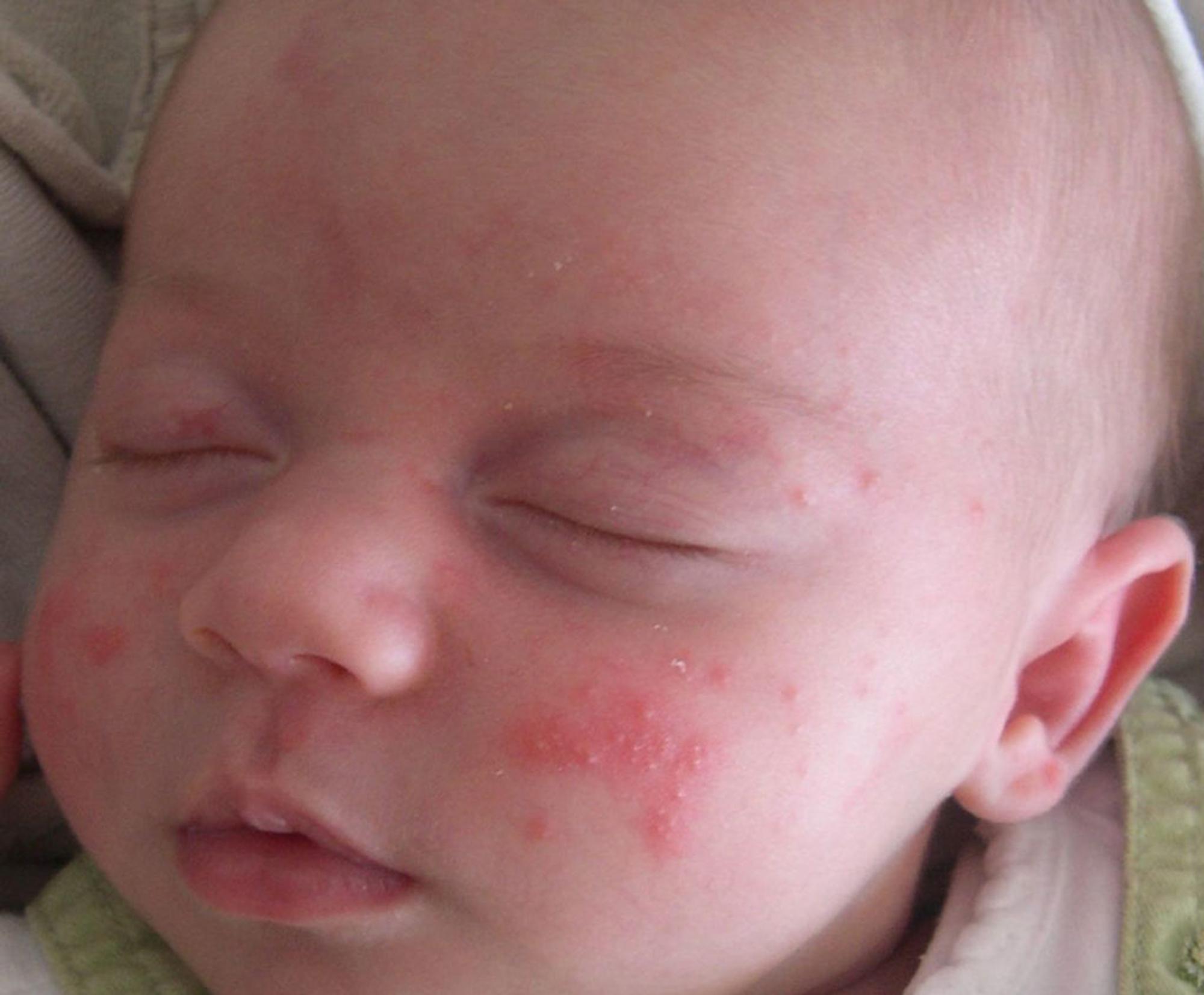 Neugeborenenakne Was Tun Gegen Die Baby Pickel Hallo Eltern