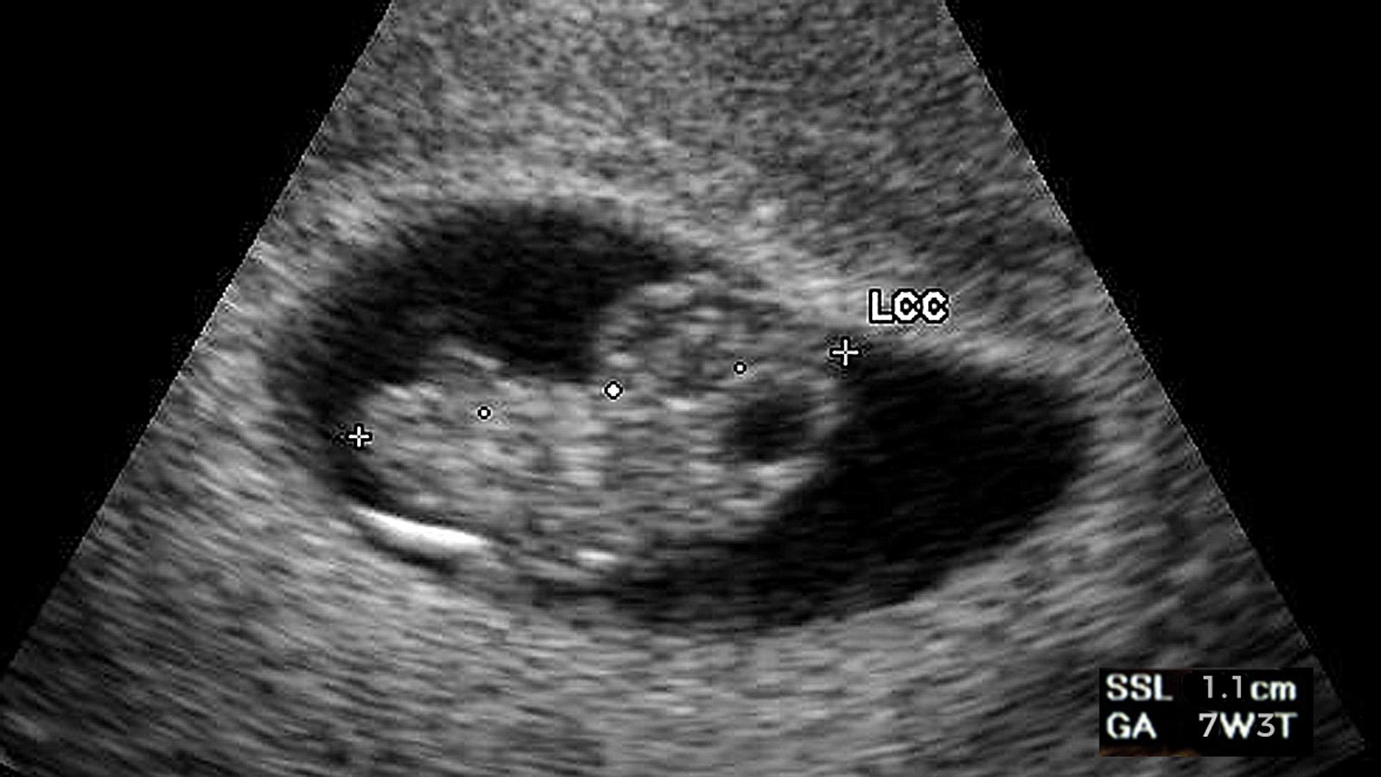 8. SSW: Ultraschall vom Embryo