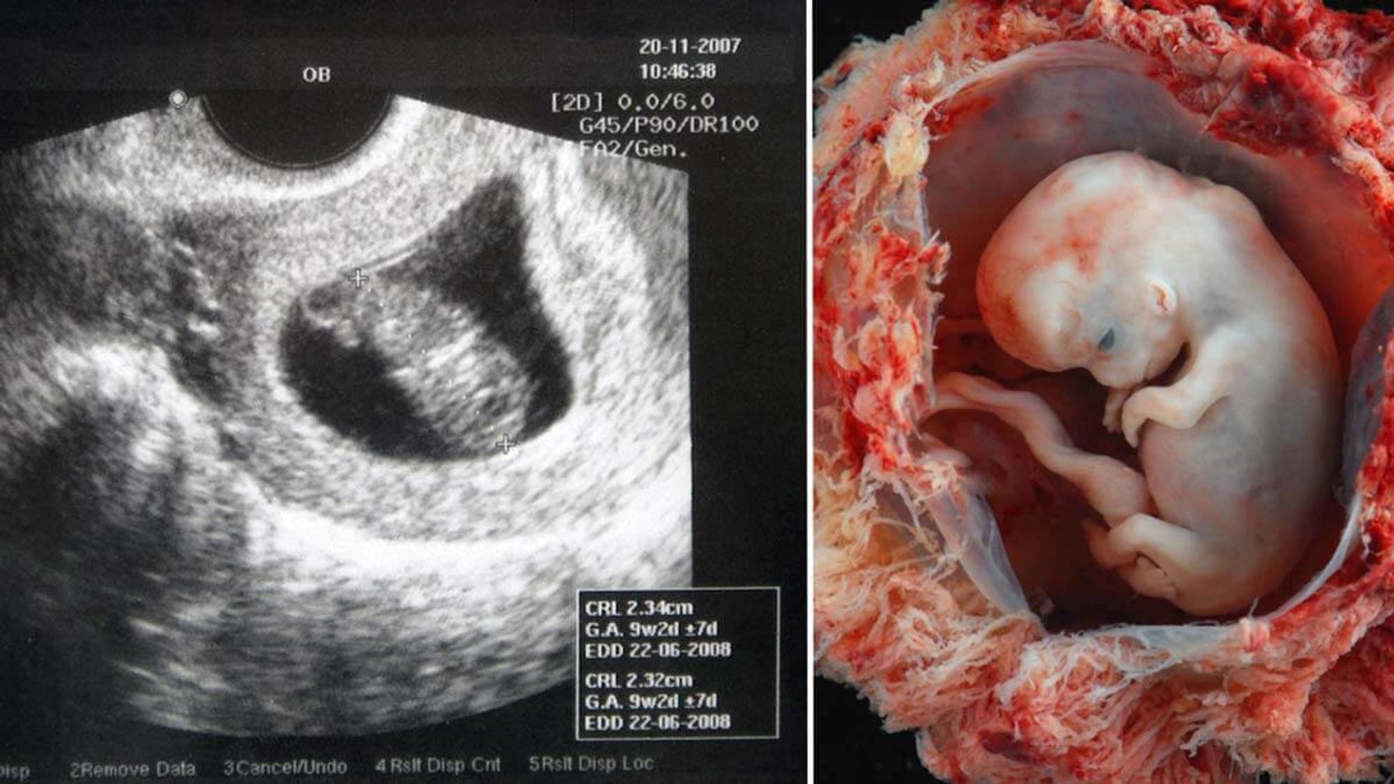 Embryo in der 11 ssw