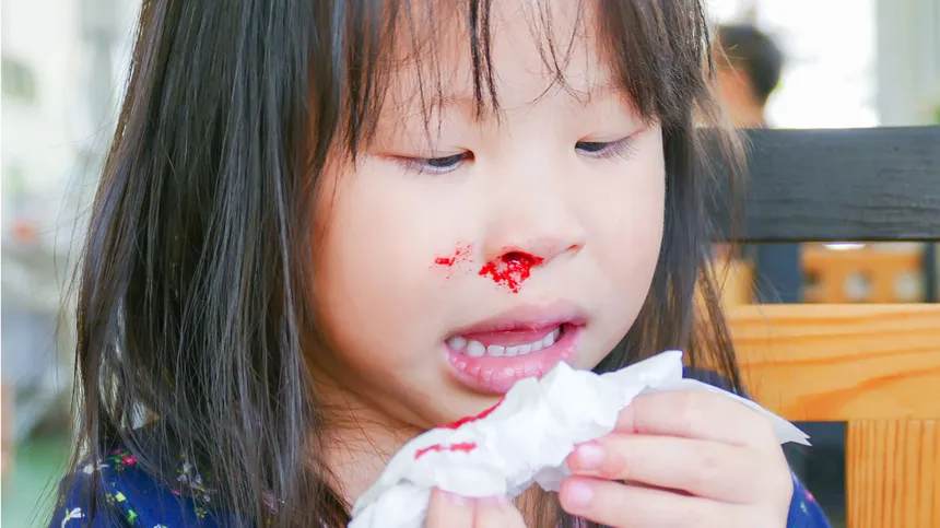 Nasenbluten bei Kindern: Das musst du wissen