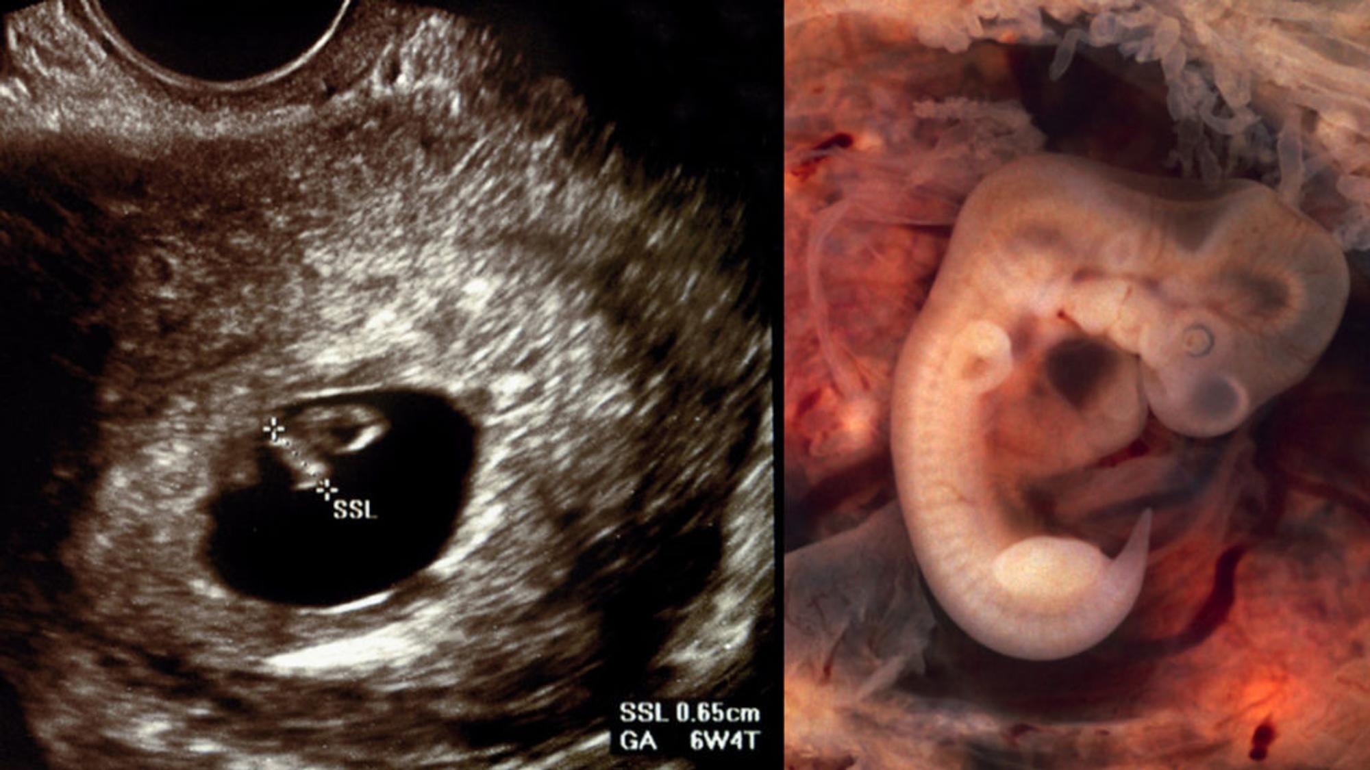 31++ 4 woche schwanger bilder , Siebte schwangerschaftswoche ultraschall. 💄 8. SSW. 20200204