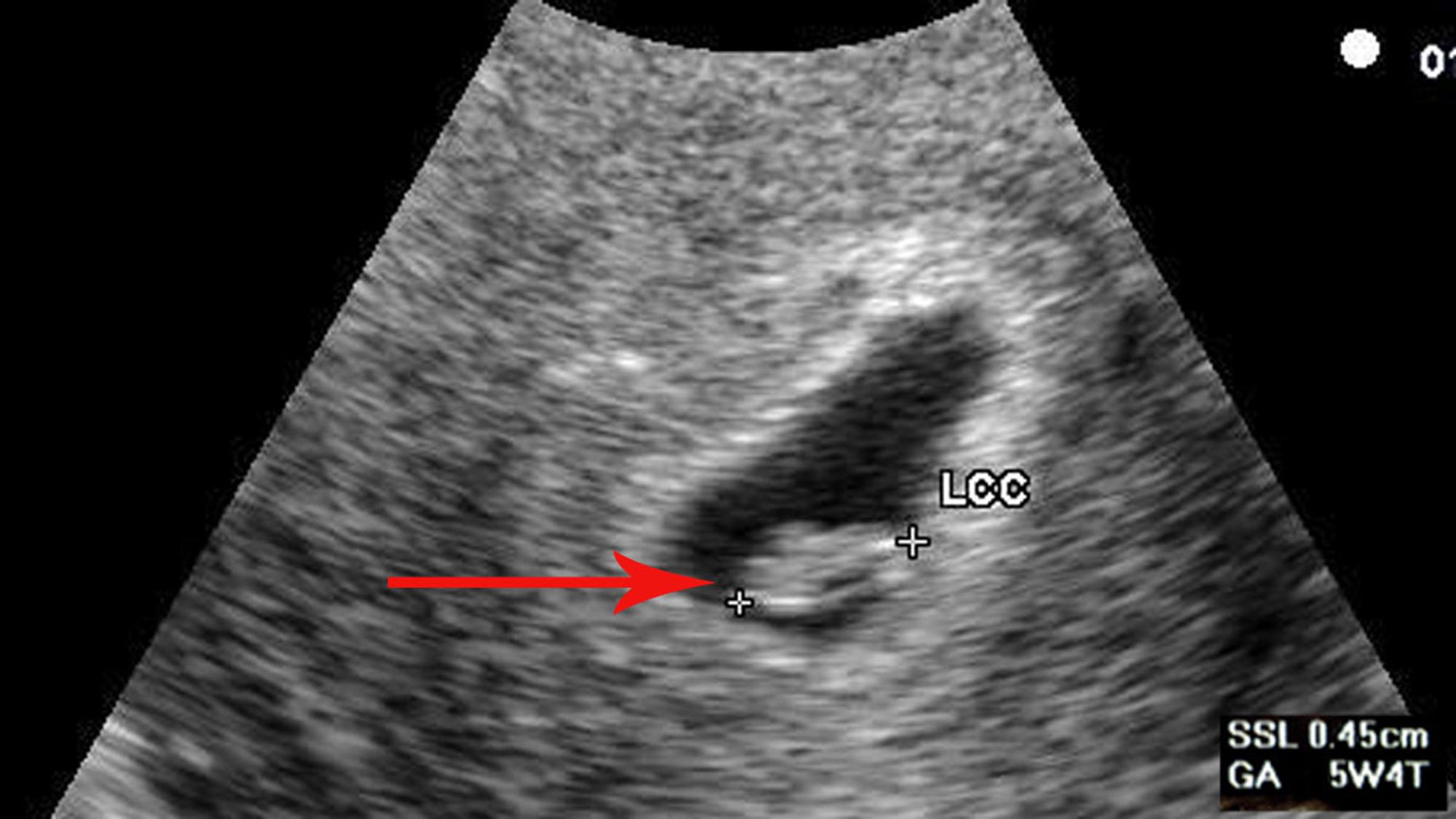 Schwangerschaft ohne ultraschall gebärmutter Ultraschall in