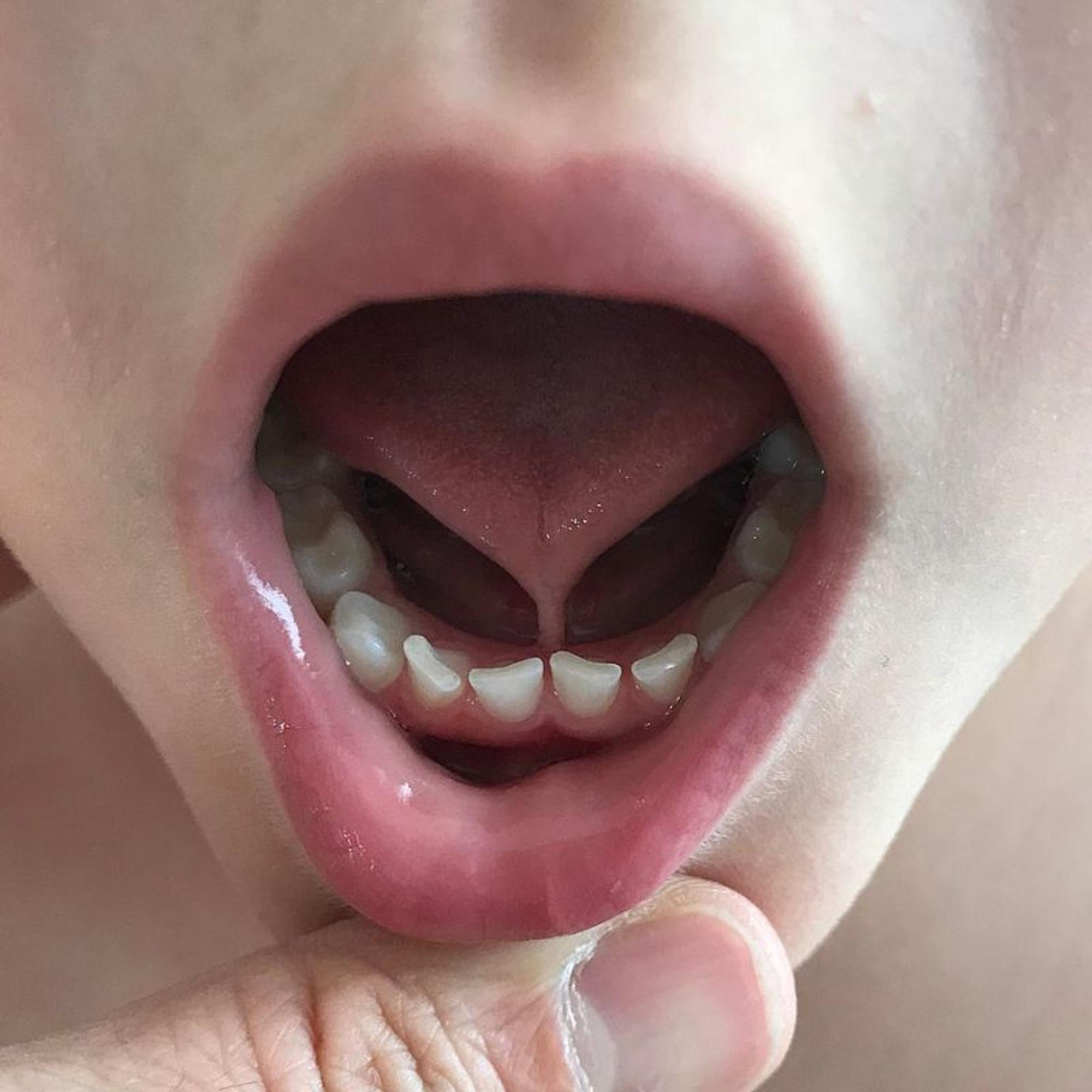 Verkürztes Zungenband
