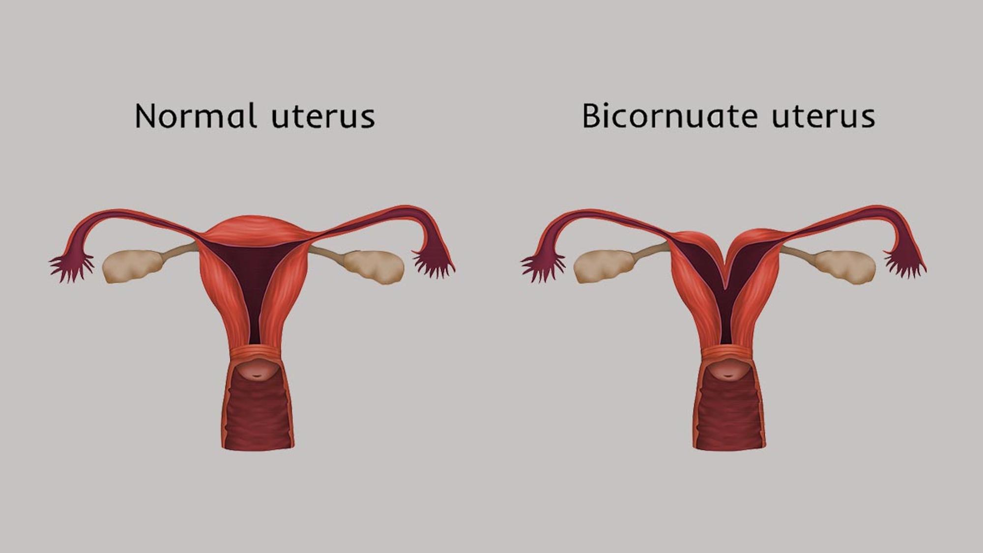 Uterus bicornis und normaler Uterus