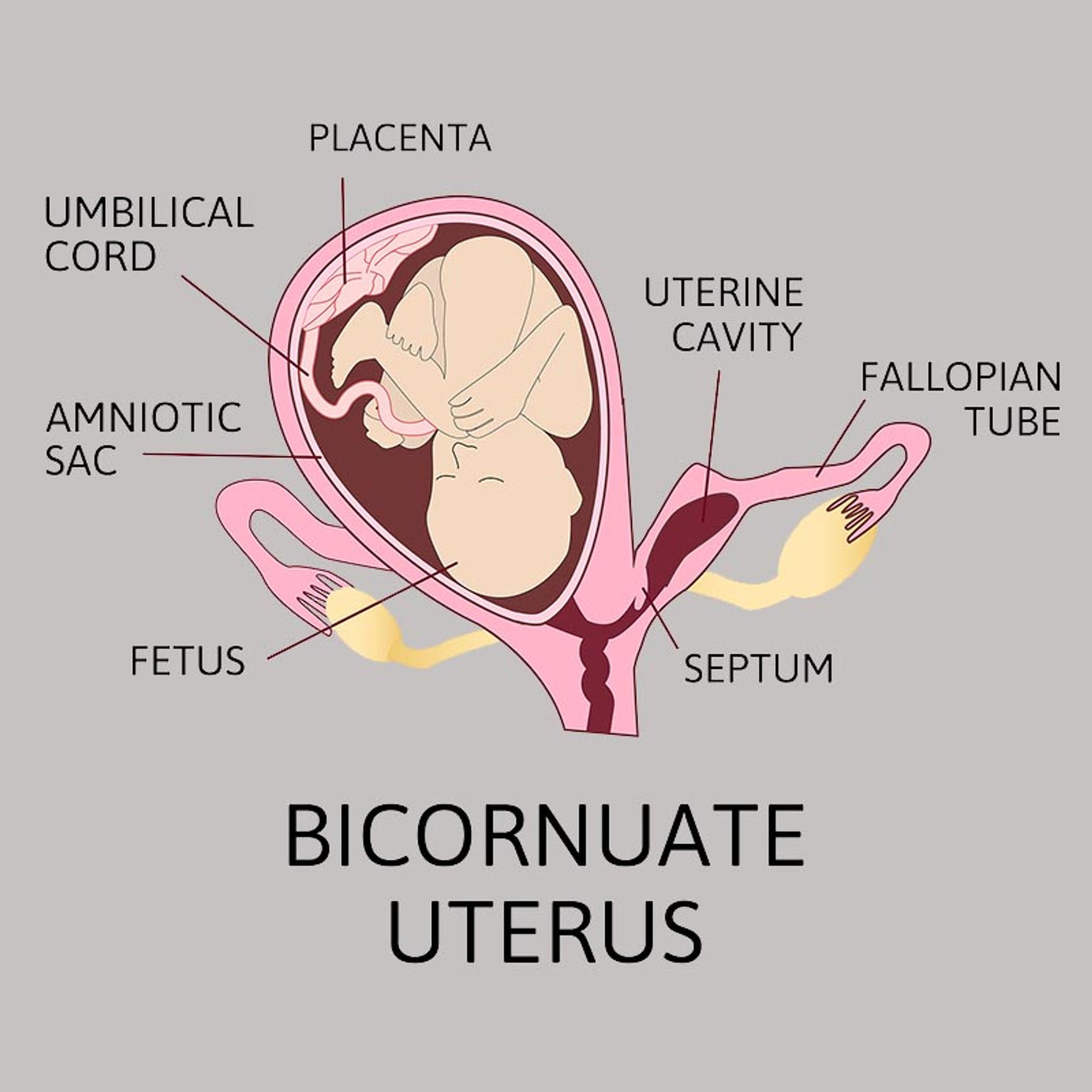 Uterus bicornis schwanger