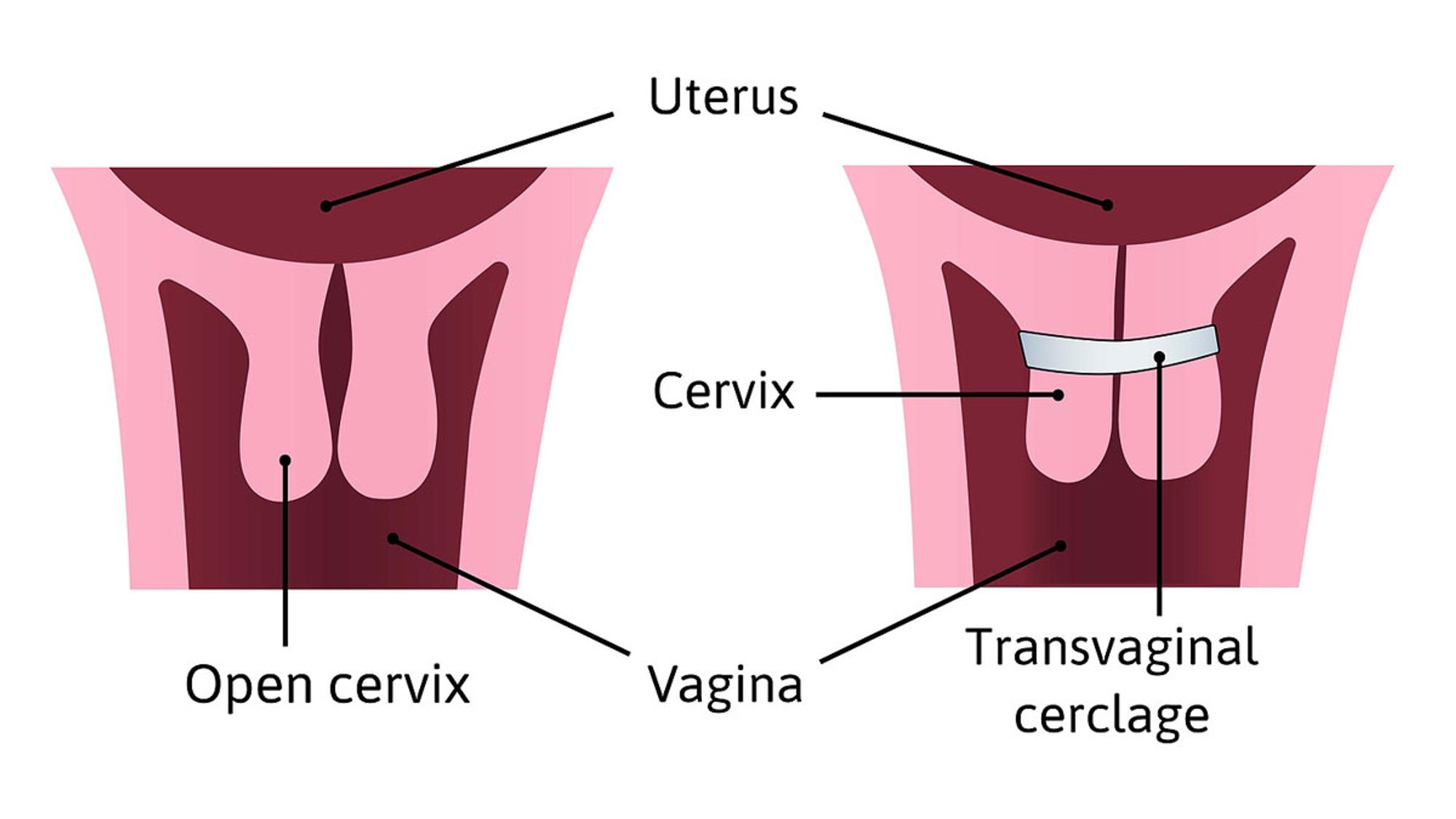 Grafik zeigt eine Zervixcerclage
