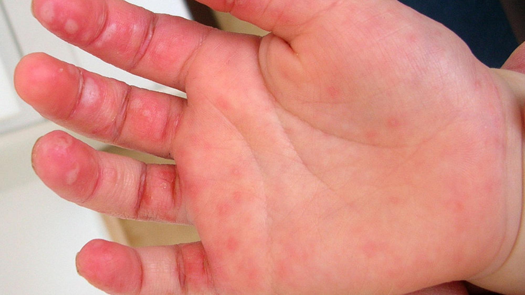 Hand-Fuß-Mund-Krankheit: Aufnahme der Hand