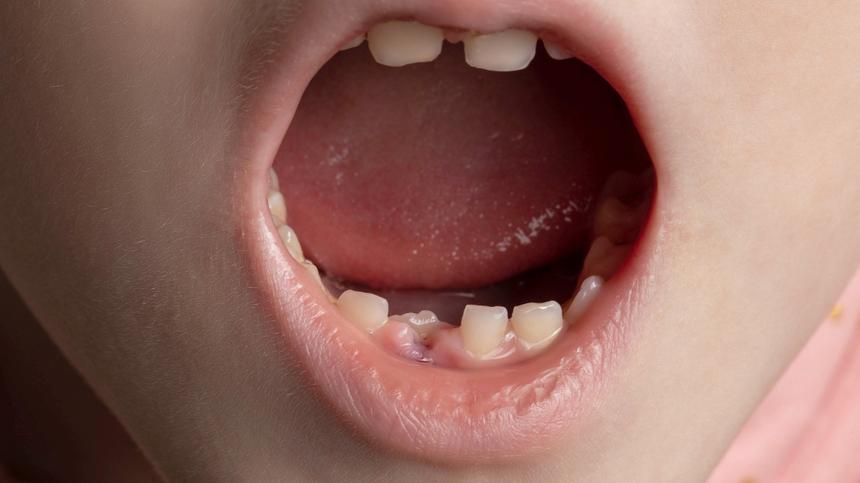 Kindermund mit geschädigten Zähnen