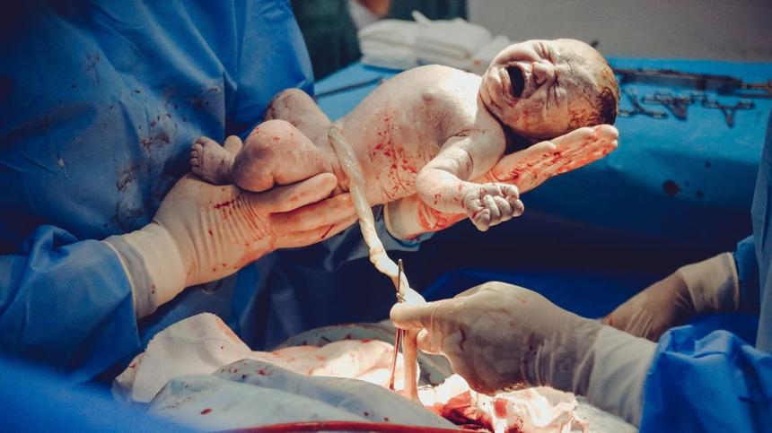 Ein Baby wird im Krankenhaus via Kaiserschnitt geboren.