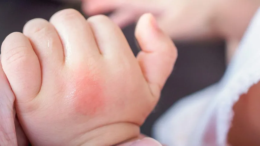 Baby mit geschwollenem Mückenstich an der Hand