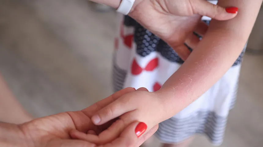 Kind mit Sonnenbrand am Arm