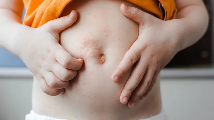 Gürtelrose bei Kindern: Ansteckung, Symptome und Behandlung