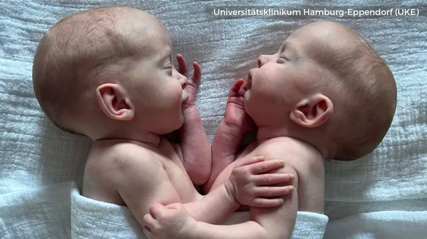 Zwillinge erfolgreich getrennt: Mädchen waren am Bauch zusammengewachsen